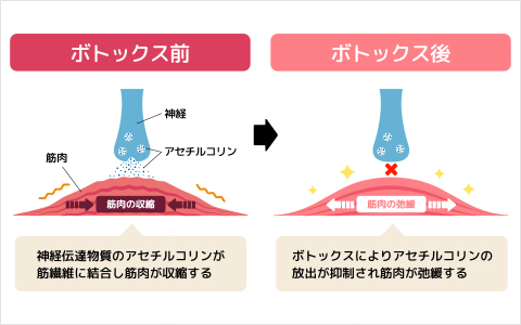 ボトックスが咬筋に作用するしくみ