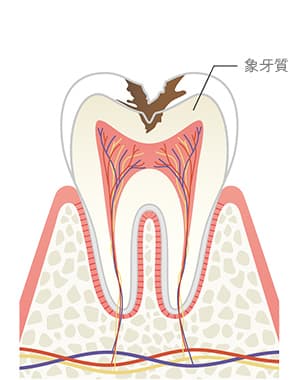 象牙質う蝕
