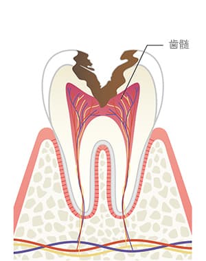 歯髄炎