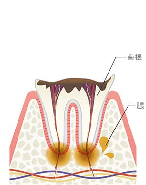 歯冠崩壊