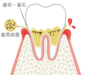 歯肉炎
