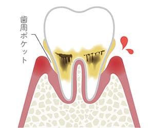 歯周炎（軽度）